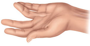 Hand-2 Hand with Dupuytrens contracture